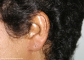 Relapsing Polychondritis