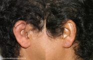 Relapsing Polychondritis