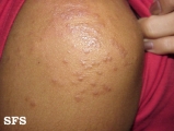 scabies atypical