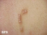 scabies atypical