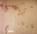 scabies atypical