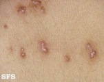 scabies atypical
