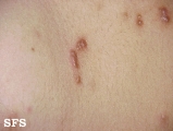 scabies atypical
