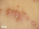 scabies atypical