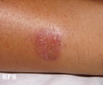 necrobiosis lipoidica