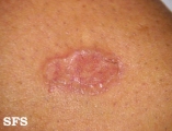 necrobiosis lipoidica