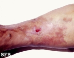 necrobiosis lipoidica
