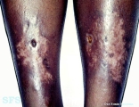 necrobiosis lipoidica