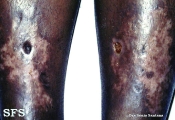 necrobiosis lipoidica