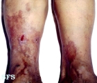 necrobiosis lipoidica