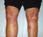 necrobiosis lipoidica