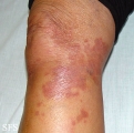 necrobiosis lipoidica