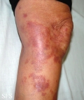 necrobiosis lipoidica
