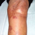 necrobiosis lipoidica