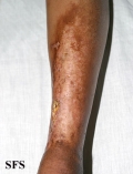 necrobiosis lipoidica