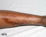 necrobiosis lipoidica