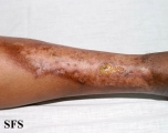 necrobiosis lipoidica