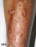 necrobiosis lipoidica