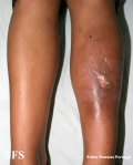 necrobiosis lipoidica
