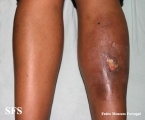 necrobiosis lipoidica