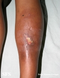necrobiosis lipoidica