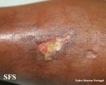 necrobiosis lipoidica