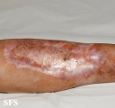 necrobiosis lipoidica