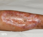 necrobiosis lipoidica