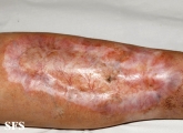 necrobiosis lipoidica