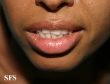 glandular cheilitis