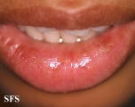 glandular cheilitis