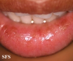 glandular cheilitis