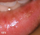 glandular cheilitis