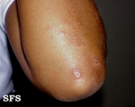 erythema elevatum diutinum