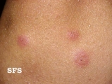 erythema elevatum diutinum