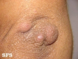 erythema elevatum diutinum