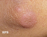 erythema elevatum diutinum