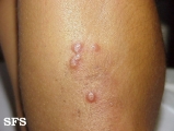 erythema elevatum diutinum