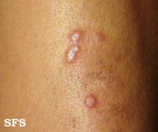 erythema elevatum diutinum