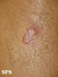 erythema elevatum diutinum