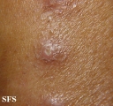 erythema elevatum diutinum