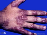 erythema elevatum diutinum