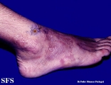 erythema elevatum diutinum