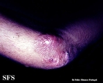 erythema elevatum diutinum