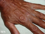 erythema elevatum diutinum