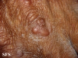 erythema elevatum diutinum