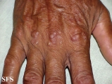 erythema elevatum diutinum