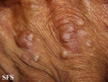 erythema elevatum diutinum