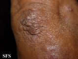 erythema elevatum diutinum