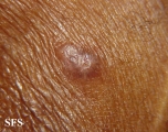 erythema elevatum diutinum